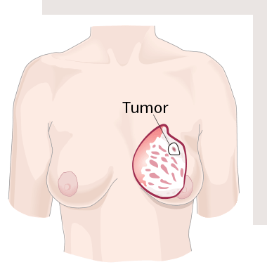 Brustkrebs - Größe und Ausdehnung des Tumors (T)